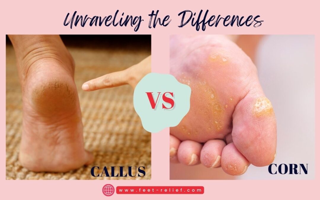 Callus vs Corn Unraveling the Differences