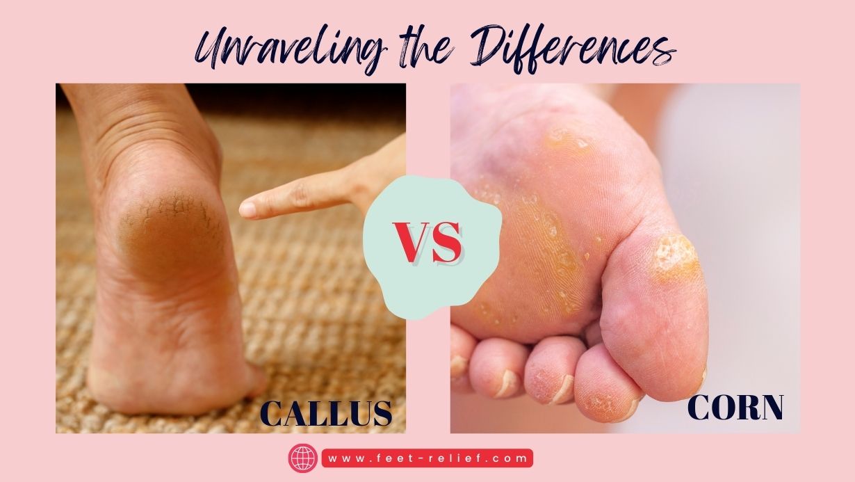 Callus Vs Corn Unraveling the Differences Feet Relief