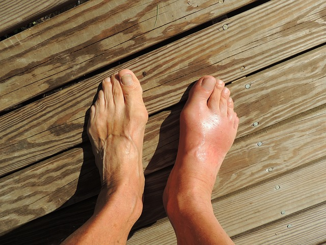 feet, gout, pain