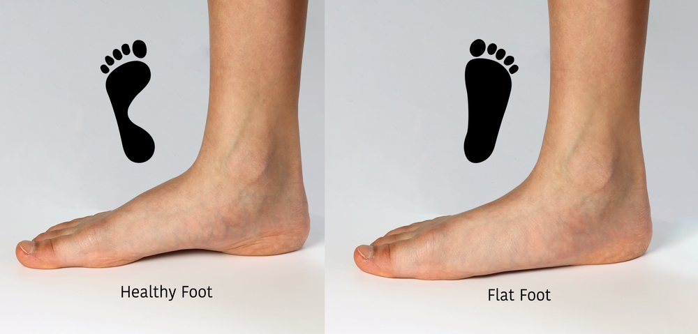 flat feet cause back pain