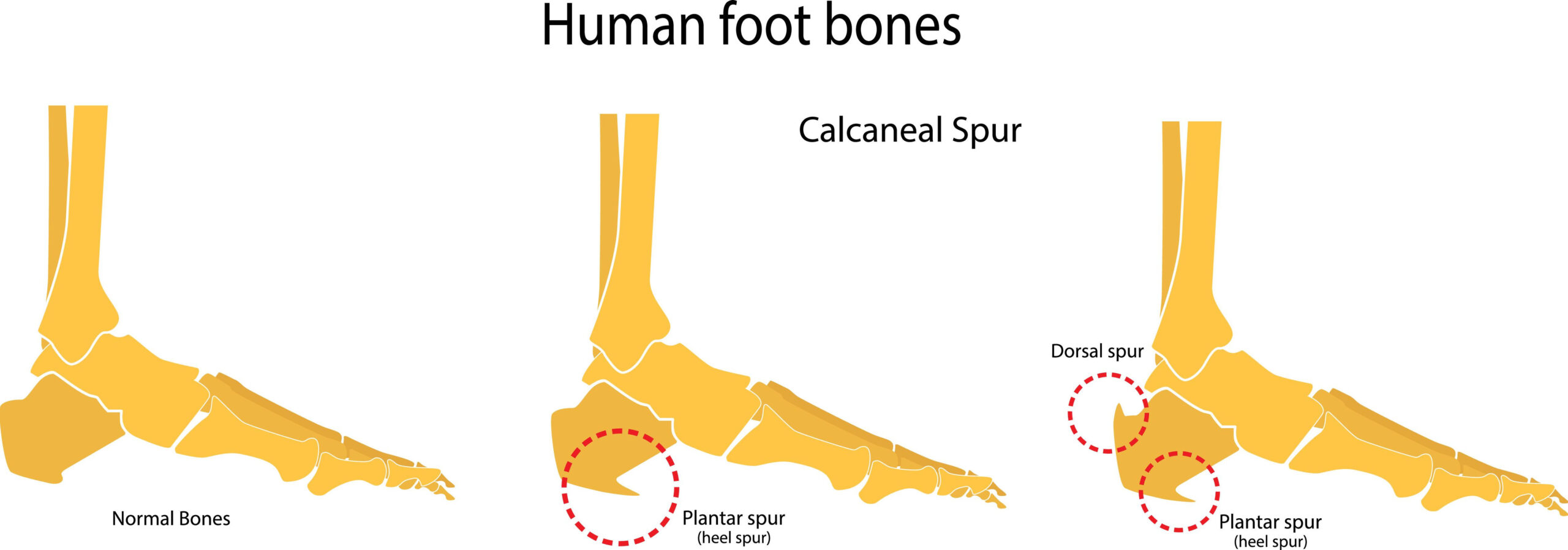 Bone Spur Foot Pain