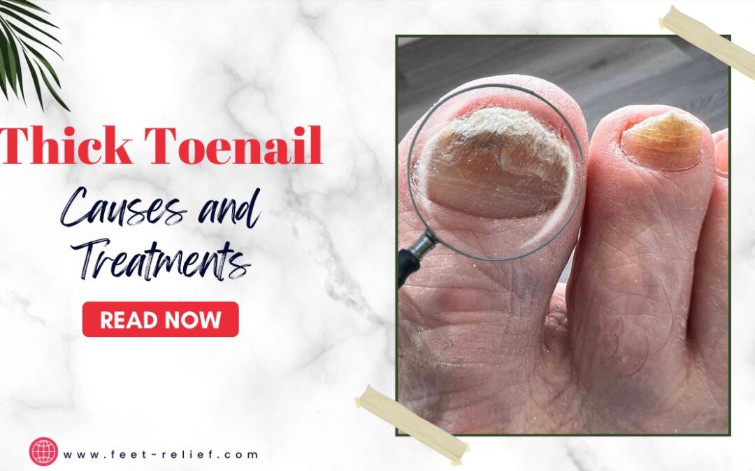 Thick Toenail Causes and Treatments
