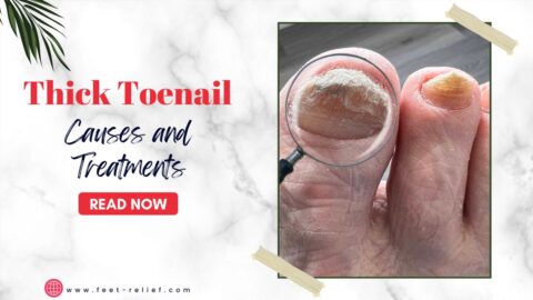 Thick Toenail Causes and Treatments