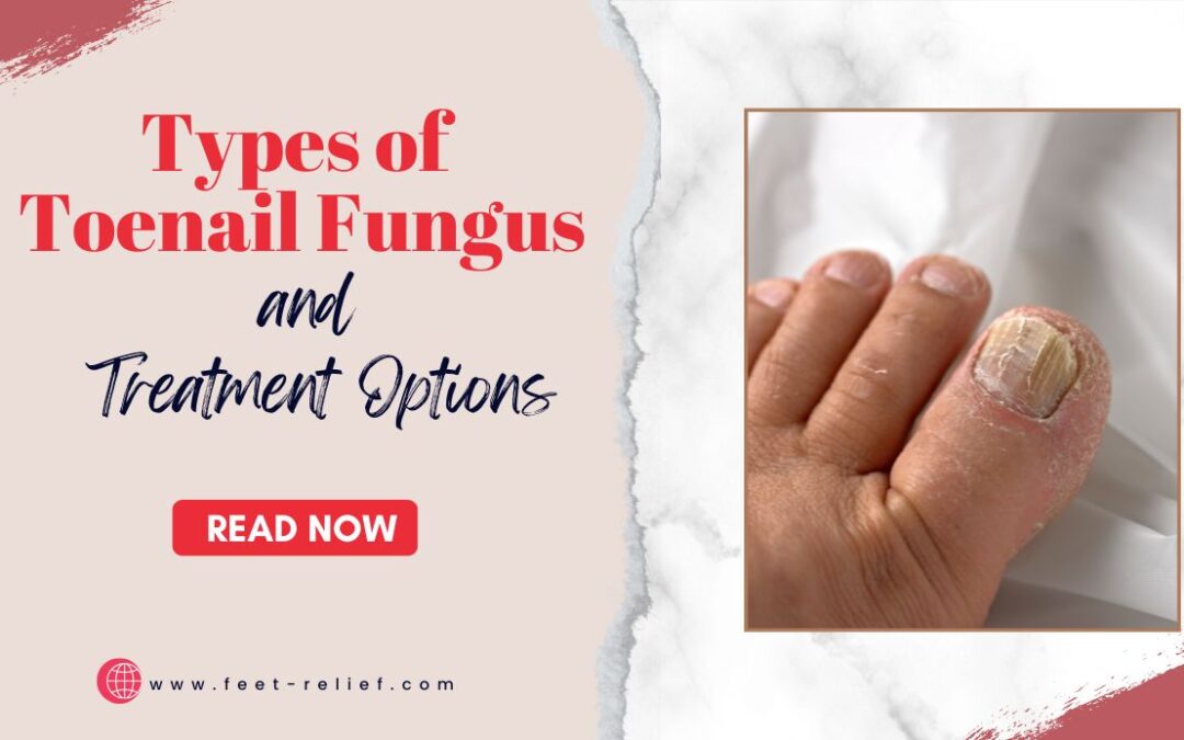 Types of Toenail Fungus and Treatment Options