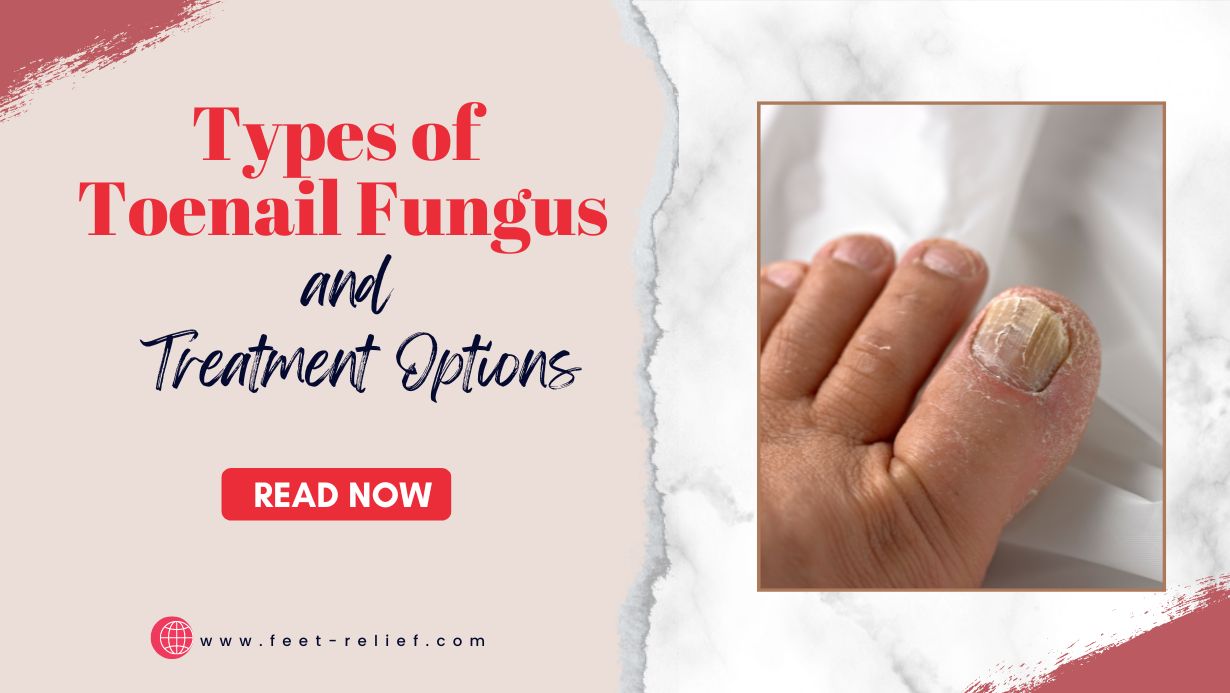 Types Of Toenail Fungus And Treatment Options Feet Relief