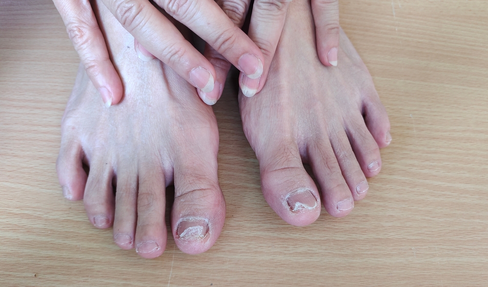 Types of Toenail Fungus and Treatment Options Feet Relief