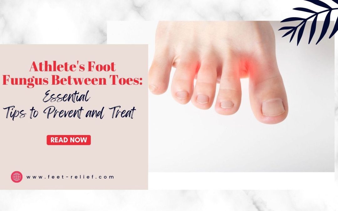 Athlete's Foot Fungus Between Toes: Essential Tips to Prevent and Treat