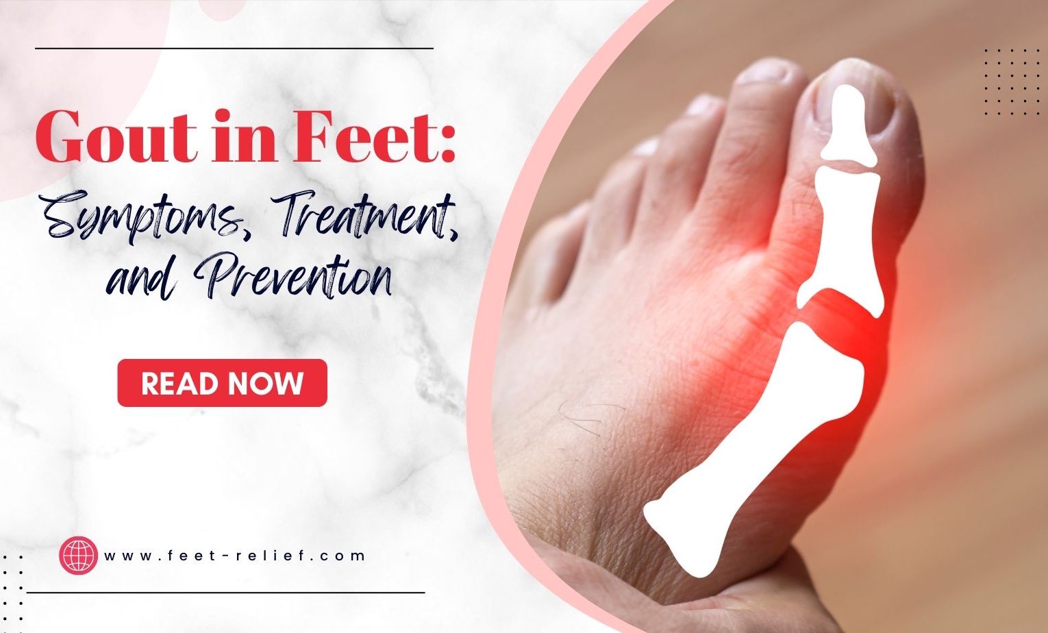 Gout in Feet: Symptoms, Treatment, and Prevention - Feet Relief