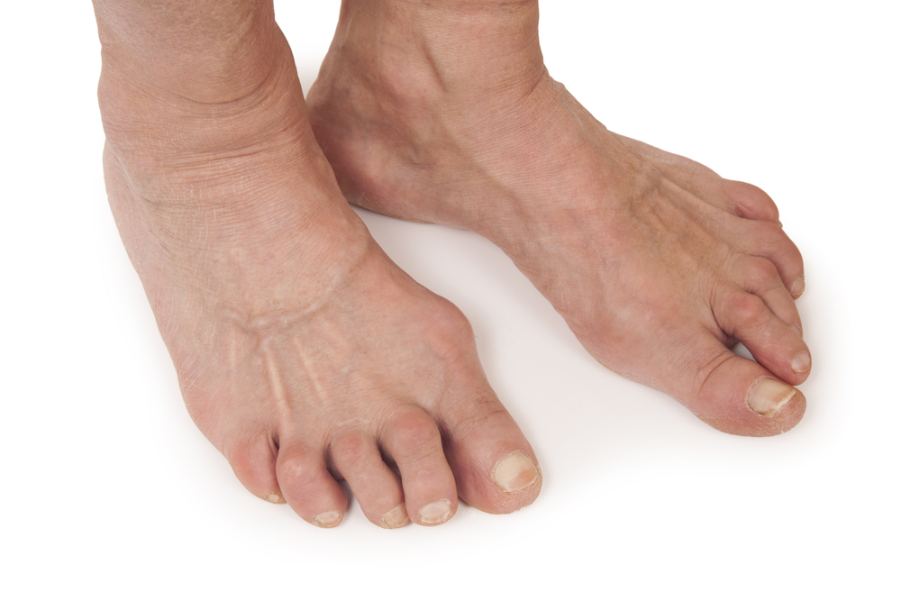 arthristis feet