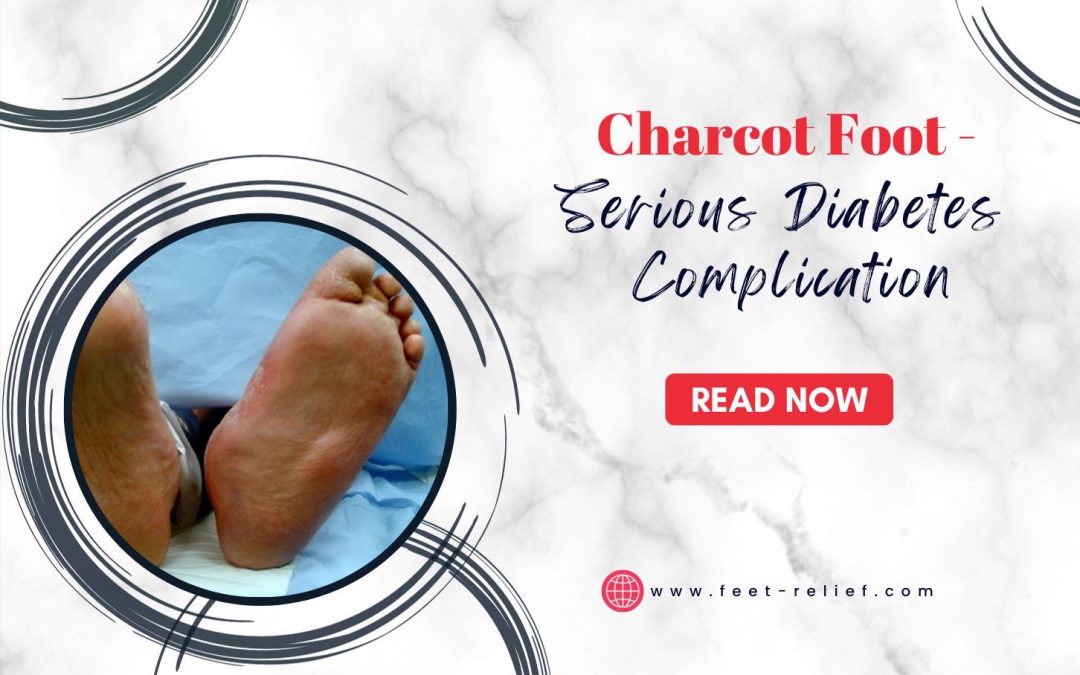 Charcot Foot – Serious Diabetes Complication