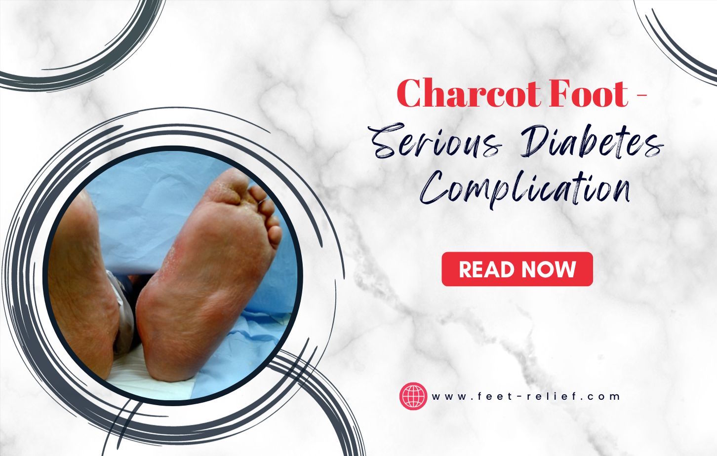 Charcot Foot - Serious Diabetes Complication - Feet Relief