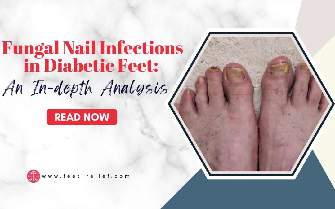 Fungal Nail Infections in Diabetic Feet: An In-depth Analysis