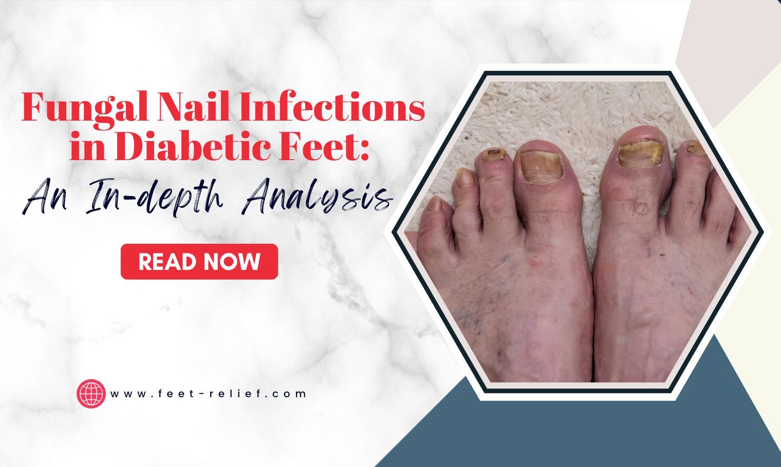 Fungal Nail Infections in Diabetic Feet An Indepth Analysis Feet Relief