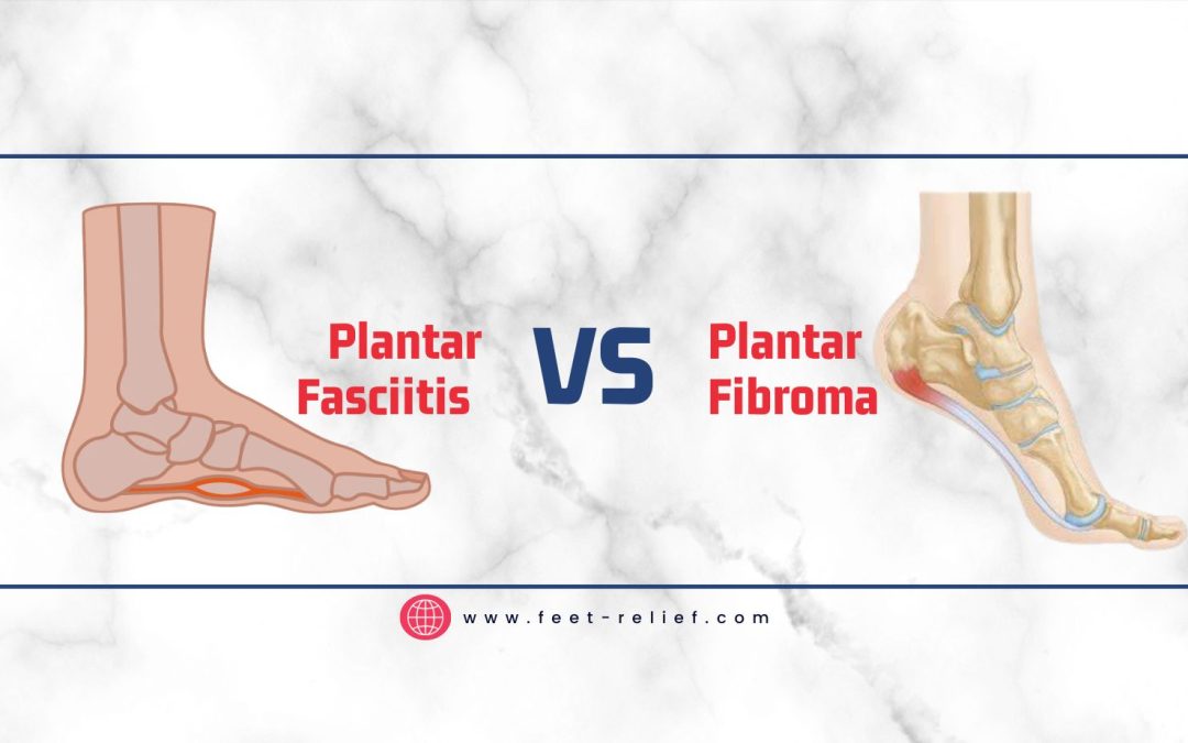 Plantar Fasciitis vs Plantar Fibroma