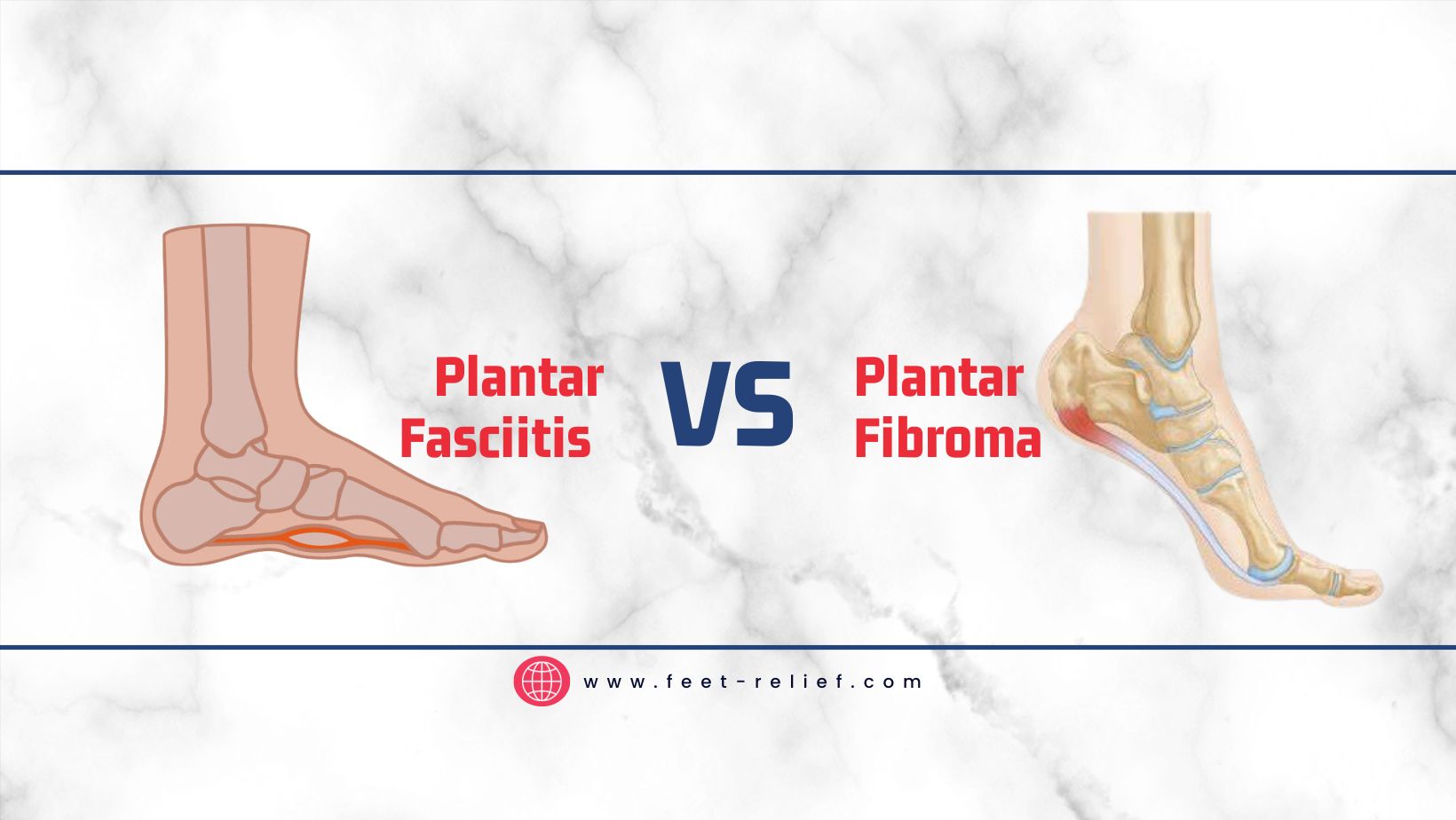 Plantar Fasciitis vs Plantar Fibroma Feet Relief