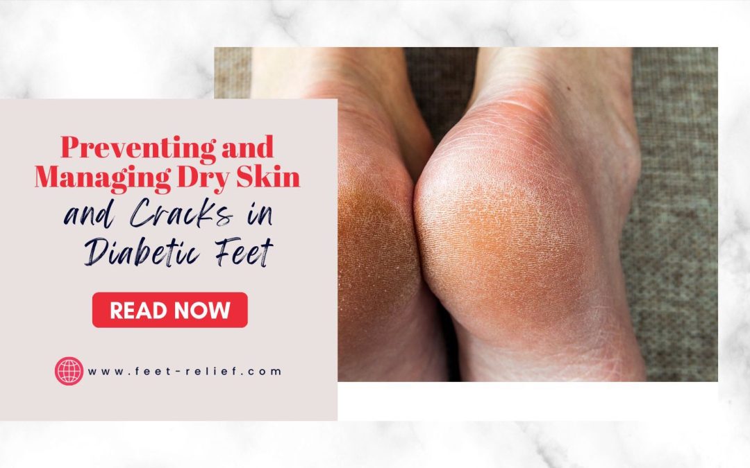 Preventing and Managing Dry Skin and Cracks in Diabetic Feet