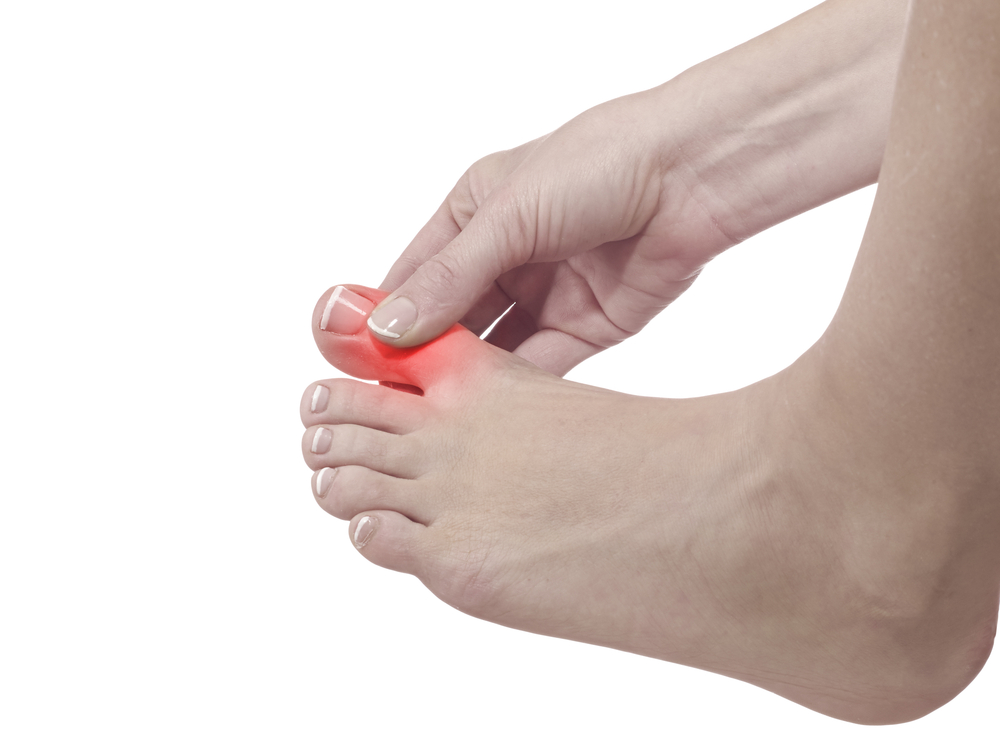 Gout in Feet: Symptoms, Treatment, and Prevention - Feet Relief