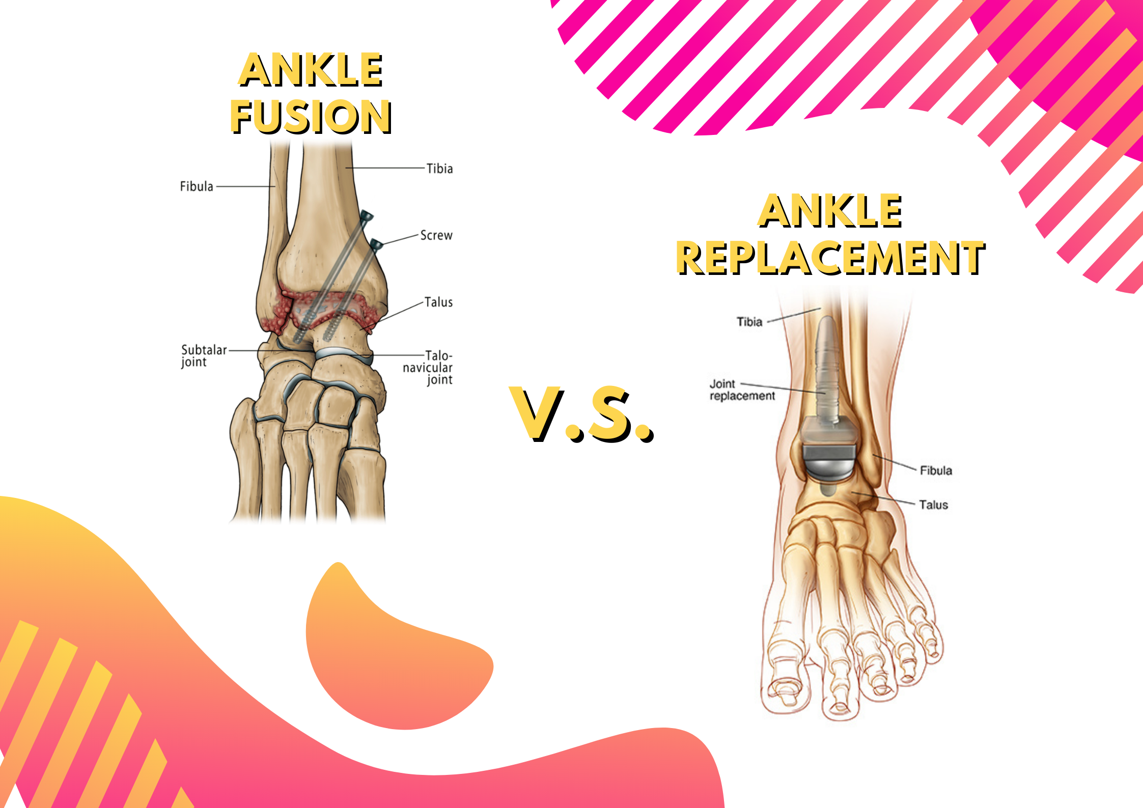 Ankle Fusion vs. Ankle Replacement