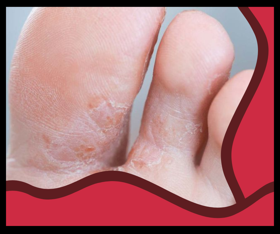 Understanding Athlete's Foot and Toenail Fungus