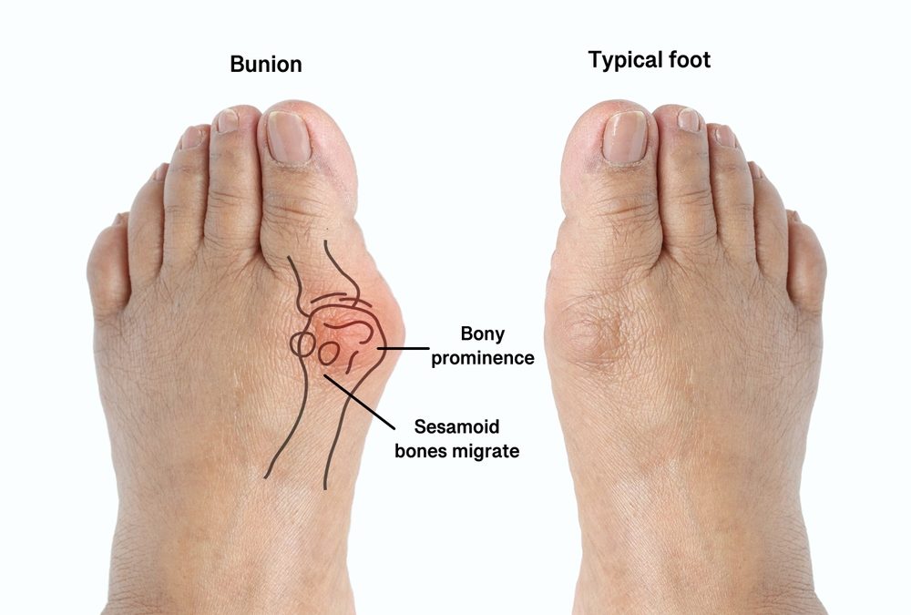 How to Treat Bunions: Effective Management and Relief Strategies