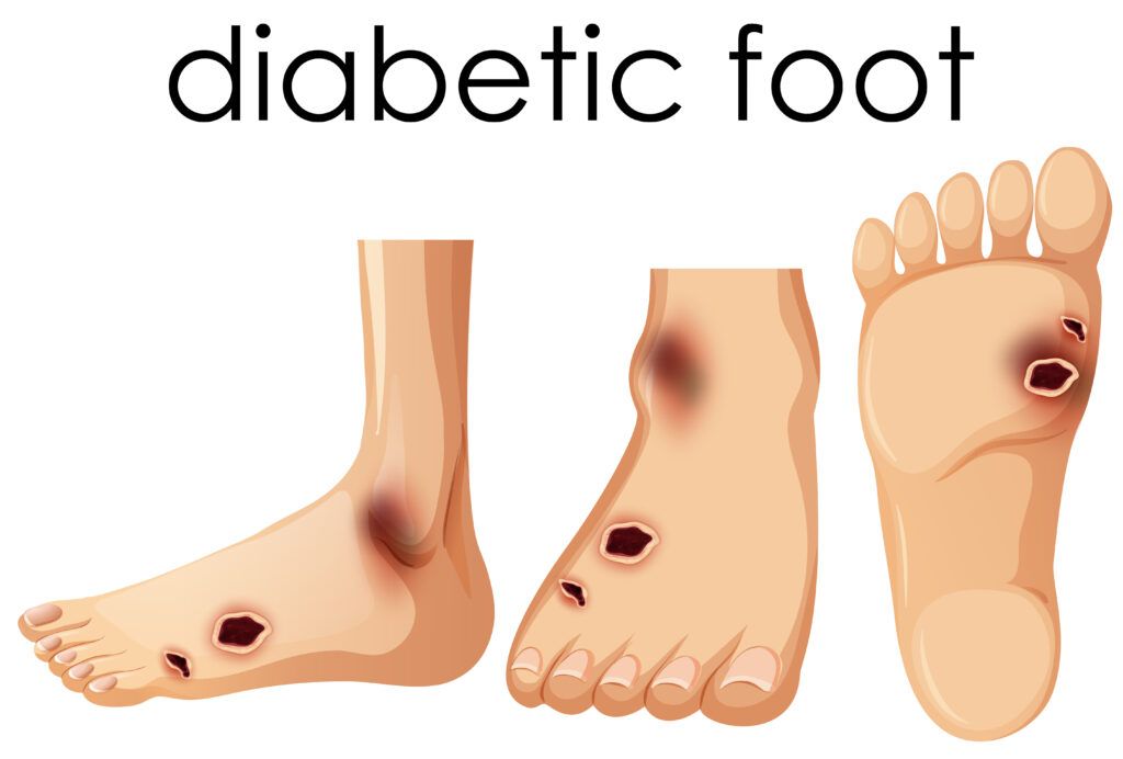 Foot Ulcers in Diabetes