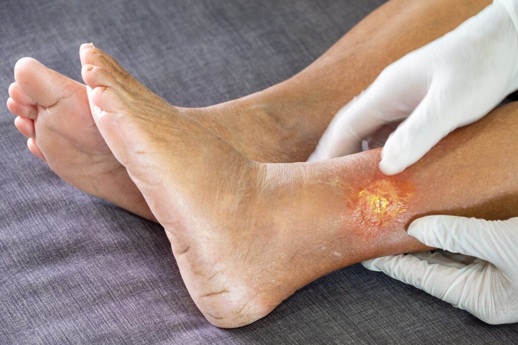 Foot Ulcers in Diabetes