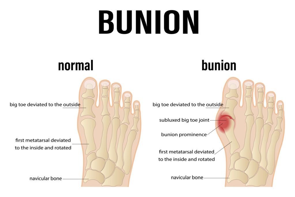 Treating Bunions